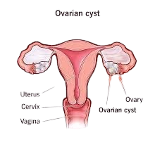 Ovarian Cysts